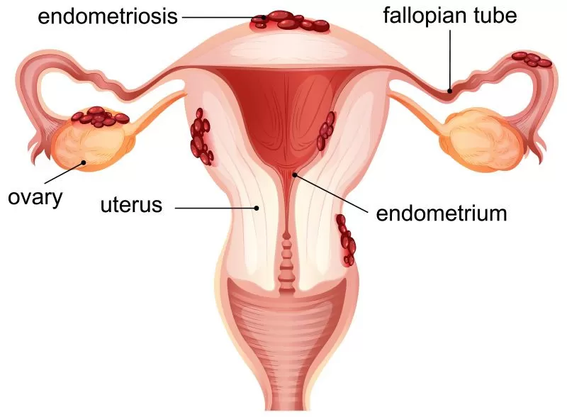 Endometrial Polip